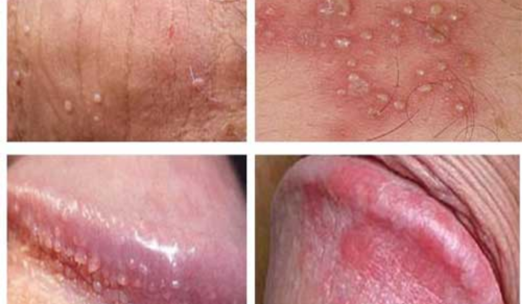 Tổng Hợp Hình Ảnh Bị Nấm Ở Vùng Kín Nam Và Cách Điều Trị