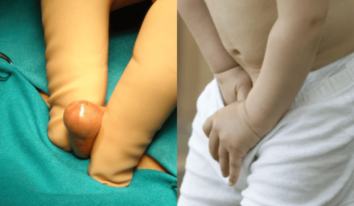 Hẹp Bao Quy Đầu Ở Trẻ: Hình Ảnh Và Cách Điều Trị