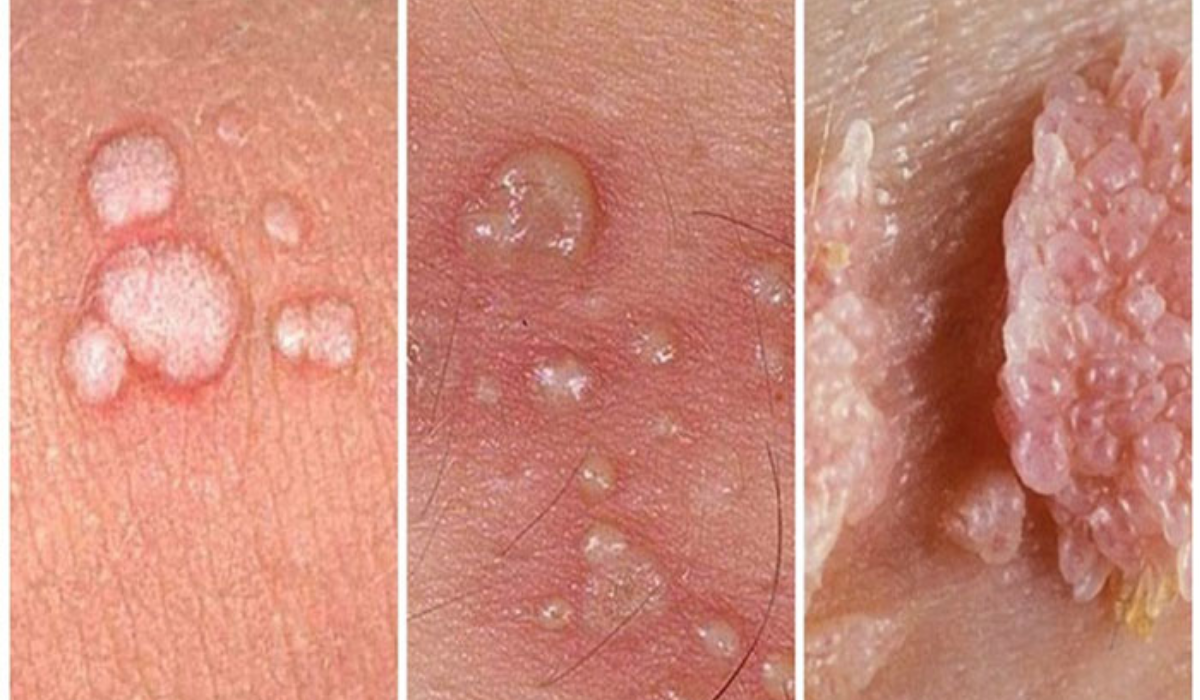 Top 4 Địa Chỉ Điều Trị Sùi Mào Gà Hậu Giang Uy Tín