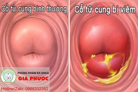Hinh anh co tu cung binh thuong va viem nhiem
