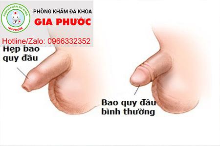 nguyen nhan gay hep bao quy dau