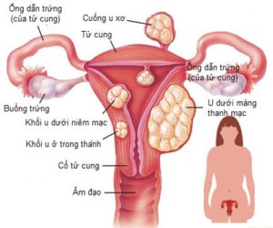 u xo tu cung nguyen nhan va cach dieu tri