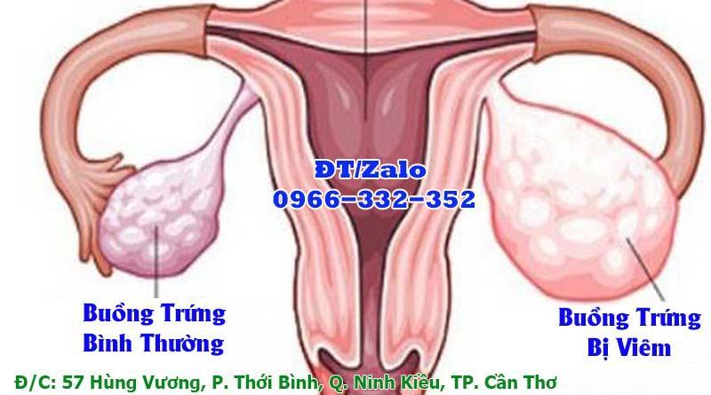 Nguyên Nhân Gây Viêm Buồng Trứng - Đa khoa Cần Thơ