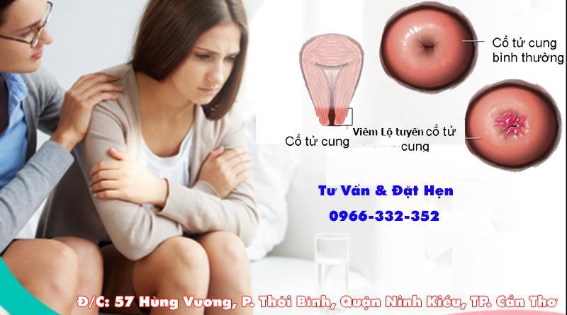 Viêm Lộ Tuyến Cổ Tử Cung - Triệu Chứng Và Cách Điều Trị
