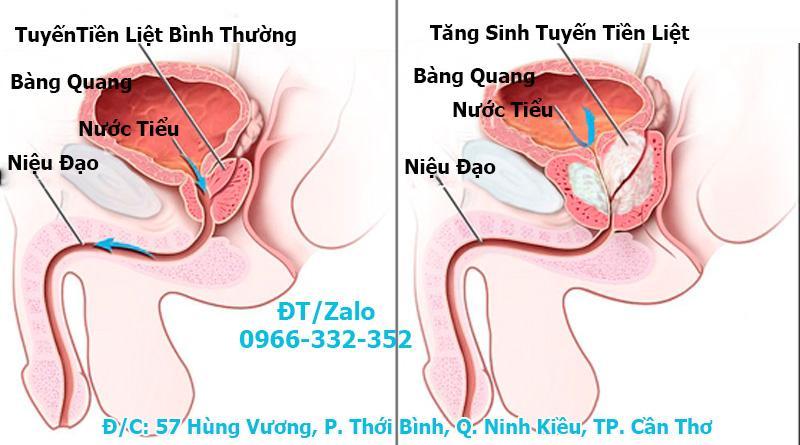 Viêm tuyến tiền liệt - Phòng khám đa khoa Cần Thơ