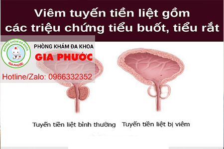 cac trieu chung cua viem tuyen tien liet