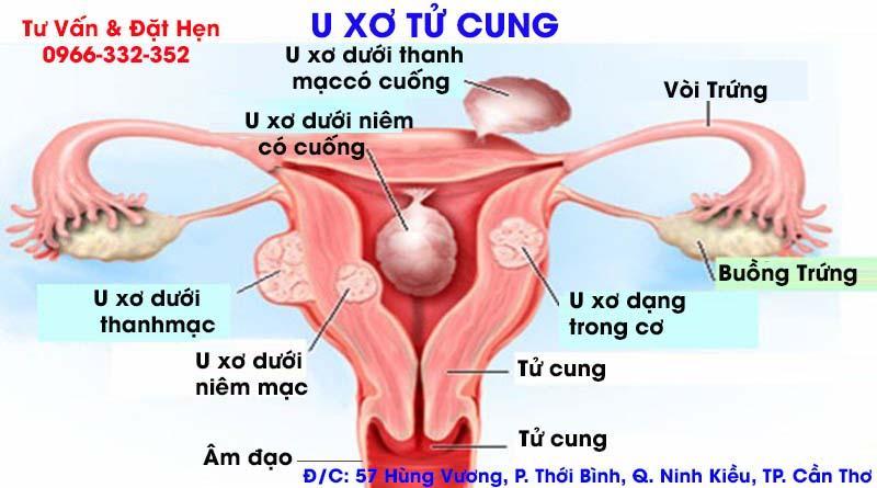 U Xơ Tử Cung- Nguyên Nhân Và Cách Điều Trị