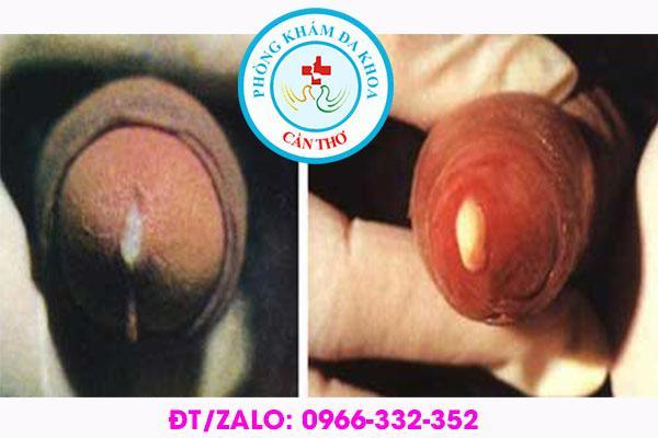 triệu chứng bệnh lậu ở nam giới