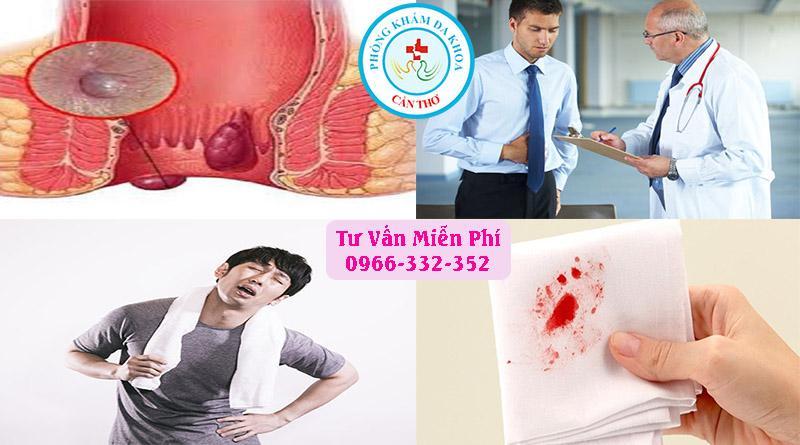Các dấu hiệu nhận biết bệnh trĩ ngoại | Phòng khám đa khoa Gia Phước