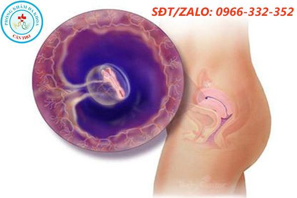 Đình chỉ thai 4 tuần tuổi