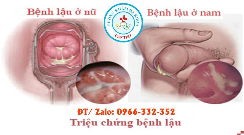 Bệnh lậu là gì? Nguyên nhân gây ra và cách phòng tránh