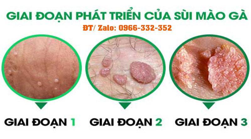 Hình ảnh về bệnh Sùi mào gà ở nam giới và nữ giới | Bệnh xã hội