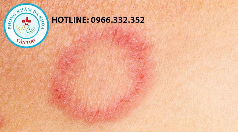 Giang Mai - Căn Bệnh Xã Hội Bị "Lãng Quên" Nhưng Cực Kỳ Nguy Hiểm
