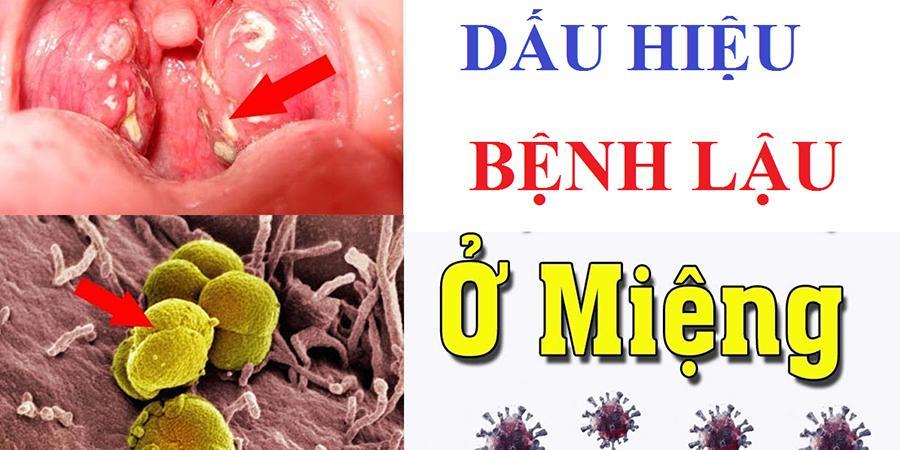 Bệnh lậu ở họng nguy hiểm thế nào? | Đa khoa Cần Thơ