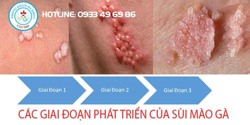 Đối tượng dễ mắc bệnh Sùi mào gà | Bệnh xã hội | Đa khoa Cần Thơ